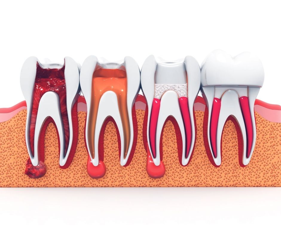 root canal treatment blackburn-dentist blackburn-what is root canal treatment